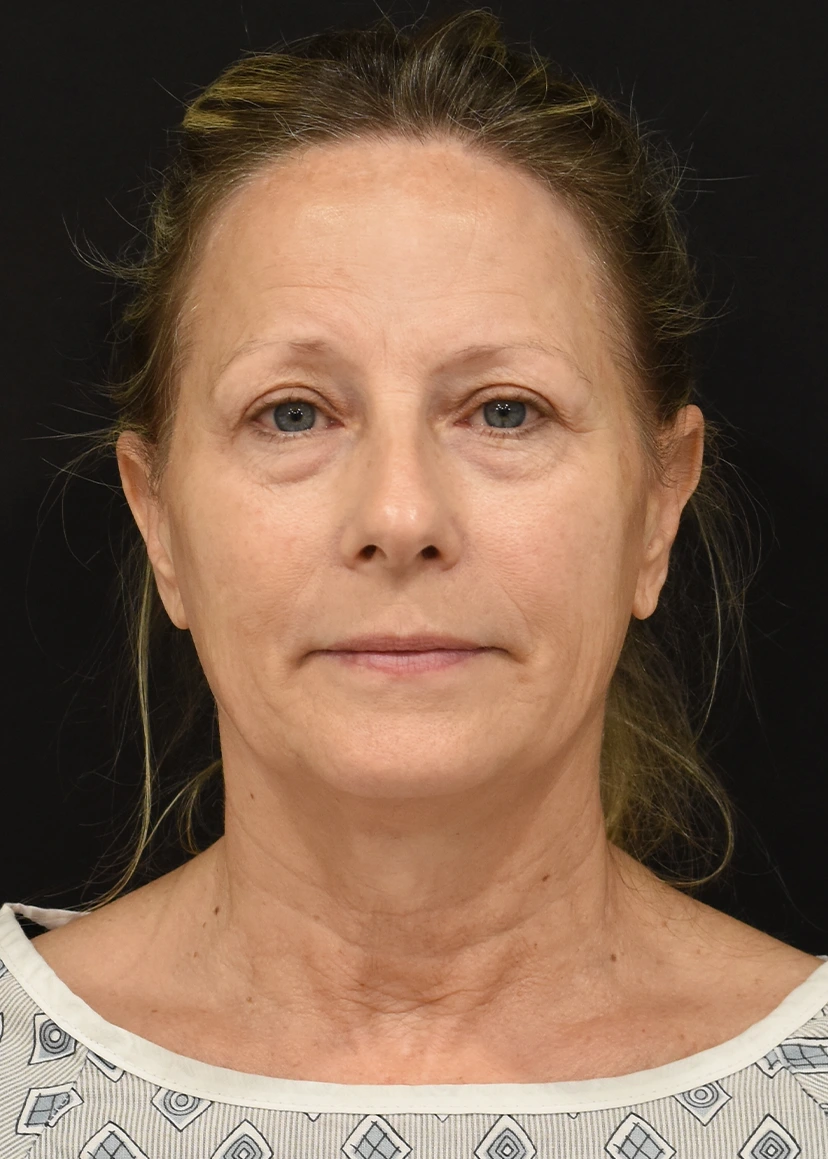 Deep Plane Facelift Patient 24 Set 1 Before